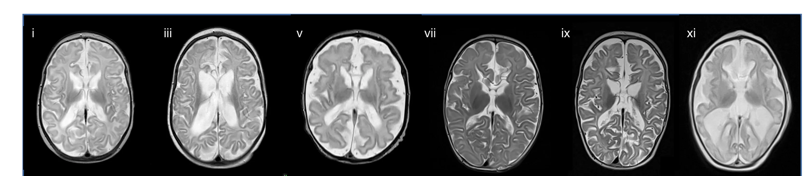 Open access visualization of Microscopy, Brain MRI, Pathogenic Variants, SNF8, T2-scans