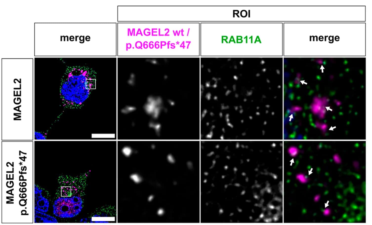 Open access visualization of Microscopy, Confocal Immunofluorescence Microscopy, Recombinant Fusion Proteins, mCherry-MAGEL2, mCherry-p.Gln666Profs*47