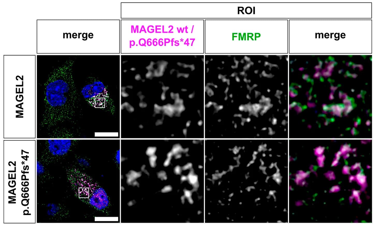 Open access visualization of Microscopy, Neuro-2a Cells, mCherry-MAGEL2, mCherry-p.Gln666Profs*47, Confocal Immunofluorescence Microscopy