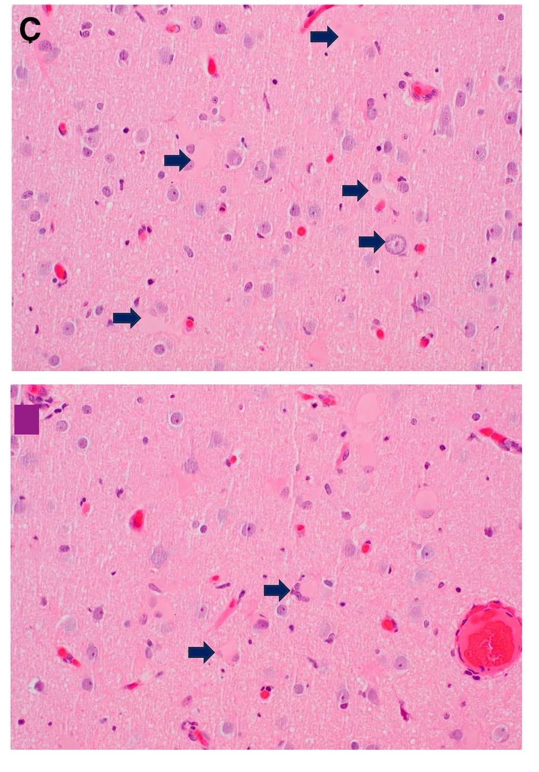 Open access visualization of Microscopy, Hematoxylin, Eosin-Stained Sections, Dysmorphic, Balloon Neurons