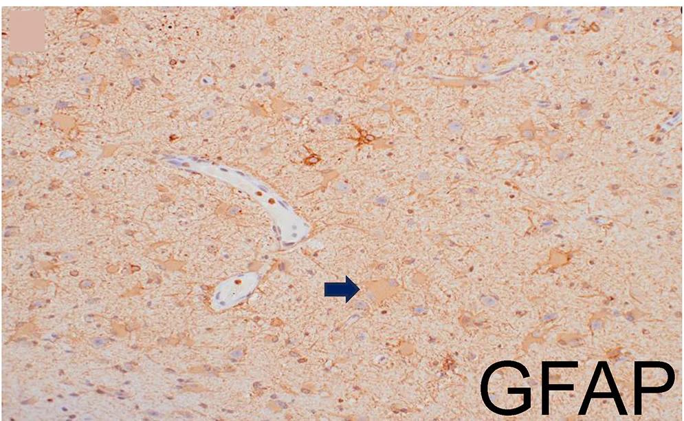 Open access visualization of Microscopy, Immunostaining, Architectural Disarray, Dysmorphic Neurons, Balloon Neurons