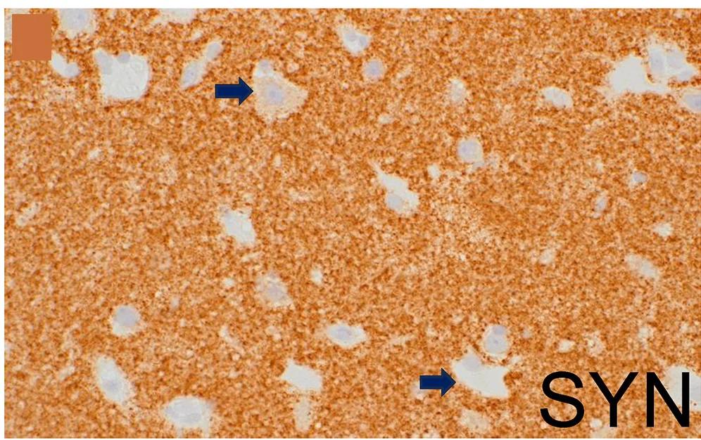 Open access visualization of Microscopy, Immunostaining, Architectural Disarray, Dysmorphic Neurons, Balloon Neurons