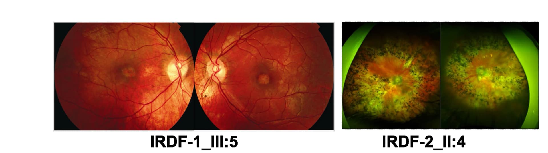 Open access visualization of Photo, Retinal Images, Macular Atrophy, Peripheral Retinal Pigmentation, Macular Degeneration