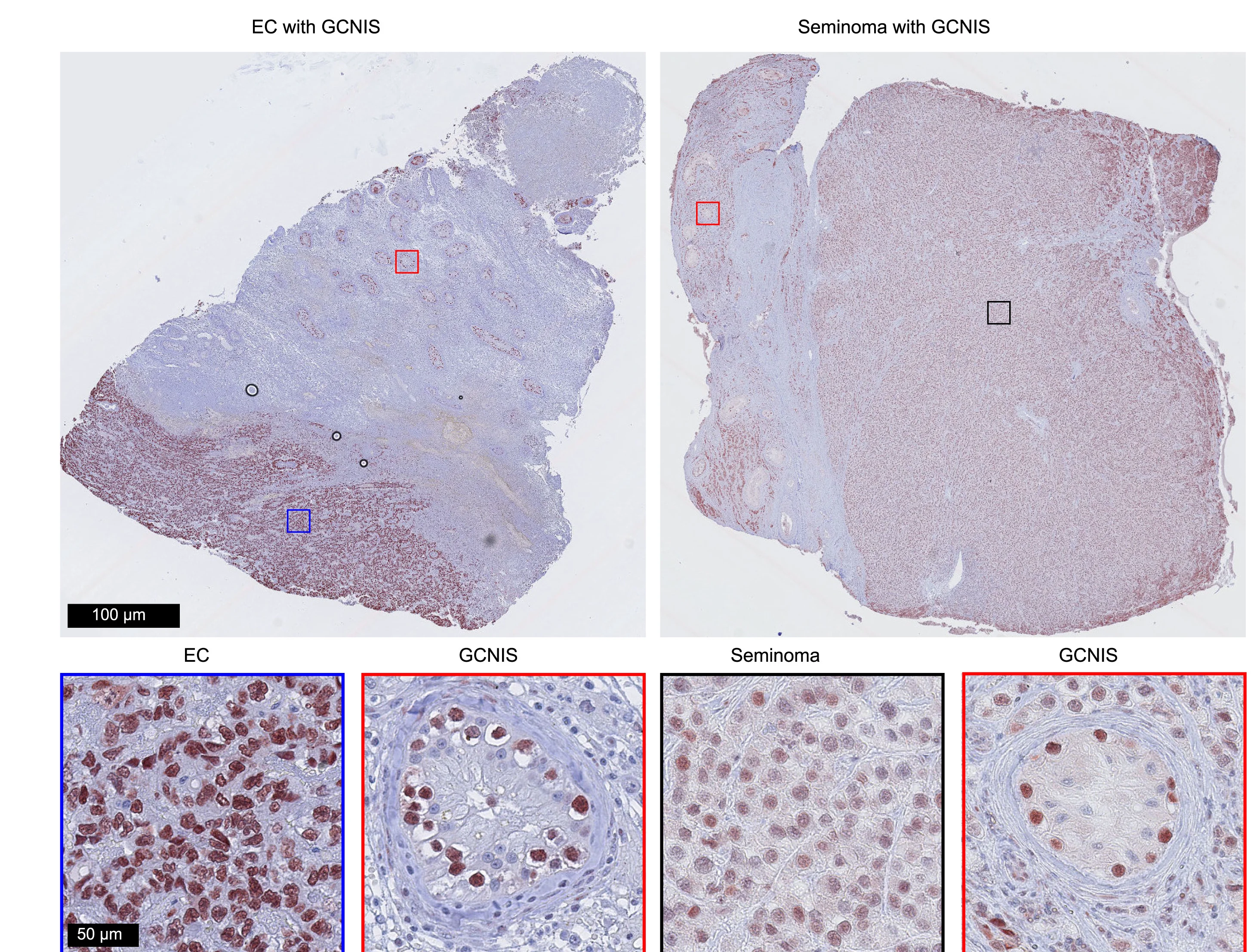 Open access visualization of Microscopy, Protein Localization, ARID3B, GCNIS, Non-seminoma