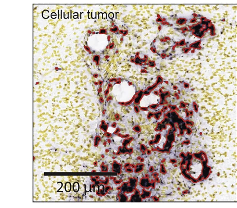 Open access visualization of Microscopy, Cellular Tumor, Invasive Tumor, RNA-ISH, COL1A1