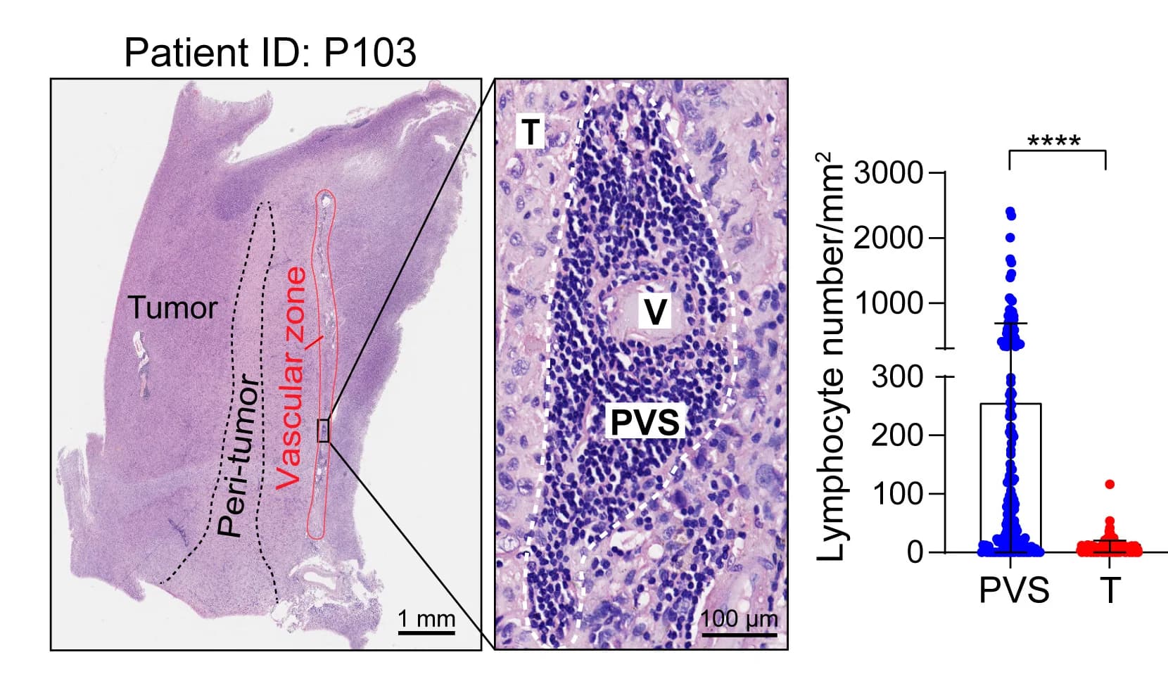 Open access visualization of Box Plot, Microscopy, Hematoxylin and Eosin Staining, Glioma Tissue