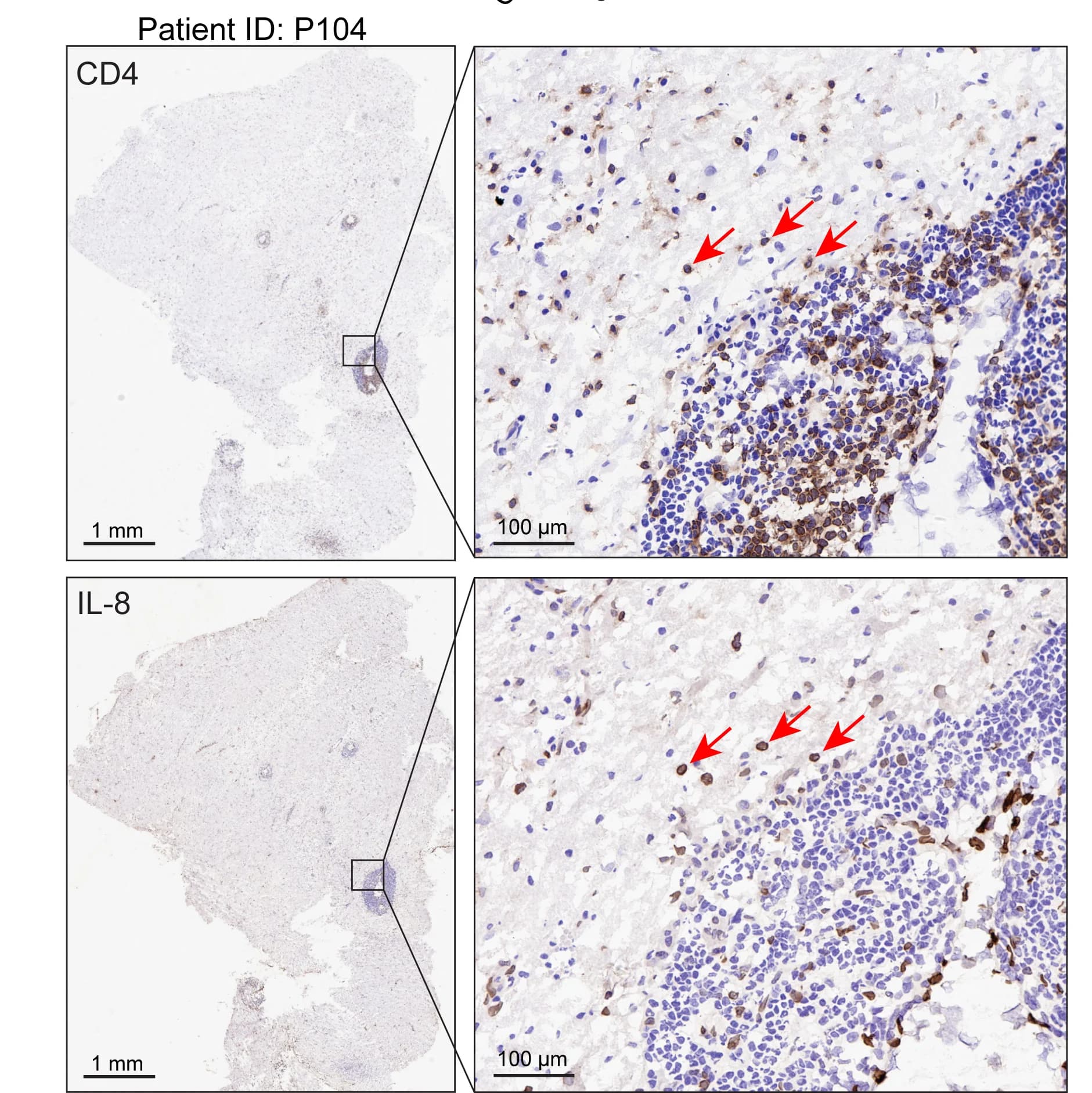 Open access visualization of Microscopy, IHC staining, Glioma Tissue, Anti-CD4 antibodies, Anti-IL-8 antibodies