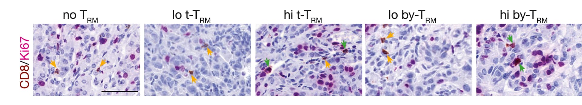Open access visualization of Microscopy, CD8, Ki67, Lung Tumors, Immunohistochemistry