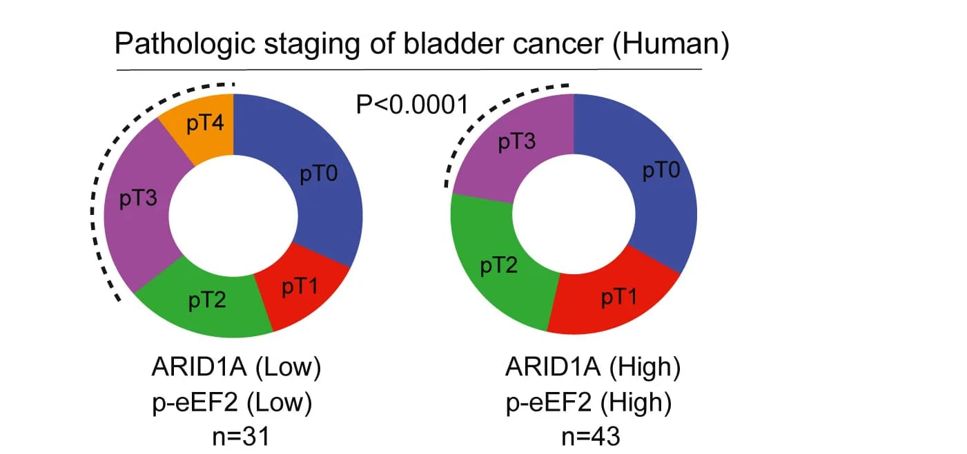 Open access visualization of Donut Chart, Clinical Staging, Chemotherapy Pathologic Staging, ARID1A, Phospho-eEF2