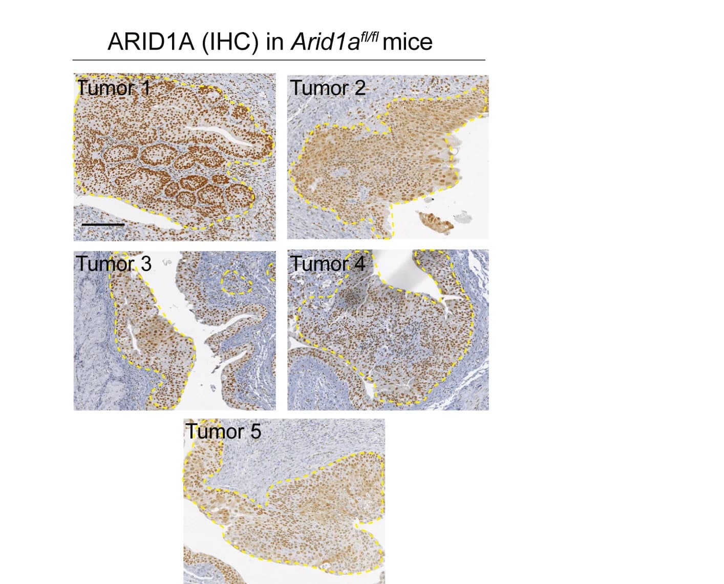 Open access visualization of Microscopy, ARID1A IHC, Arid1afl/fl Tumors, Tamoxifen, BBN Treatment