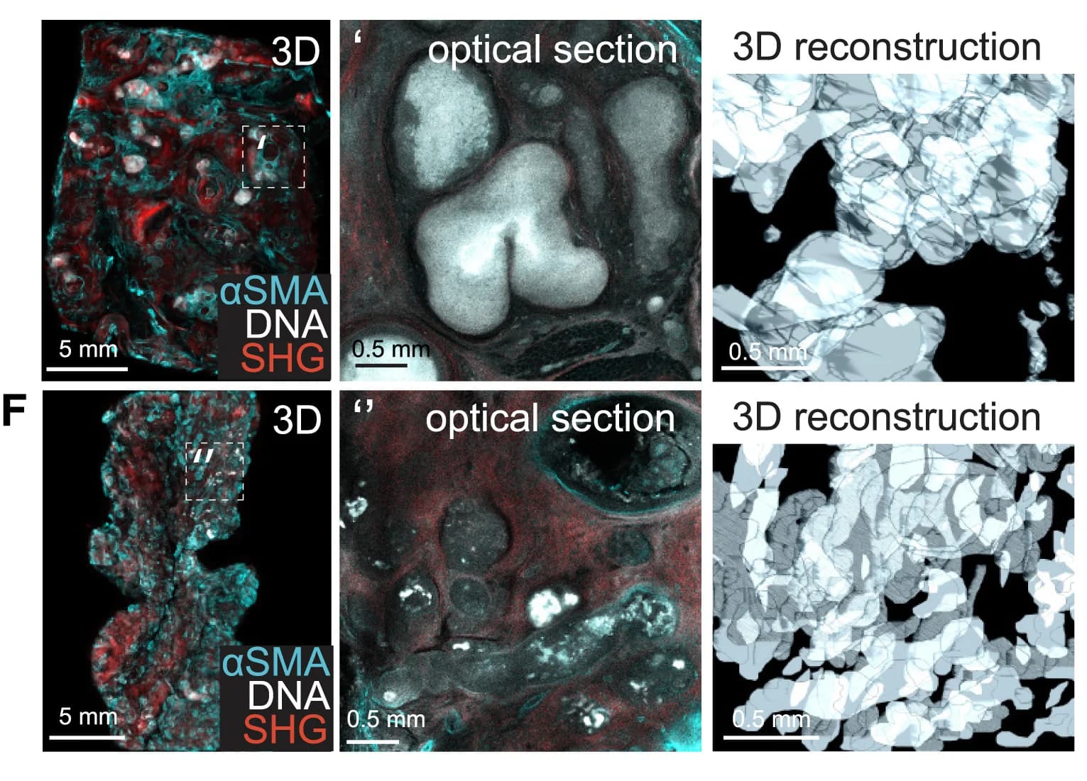Open access visualization of Microscopy, 3D Plot, 3D Morphology, FFPE Blocks, DCIS