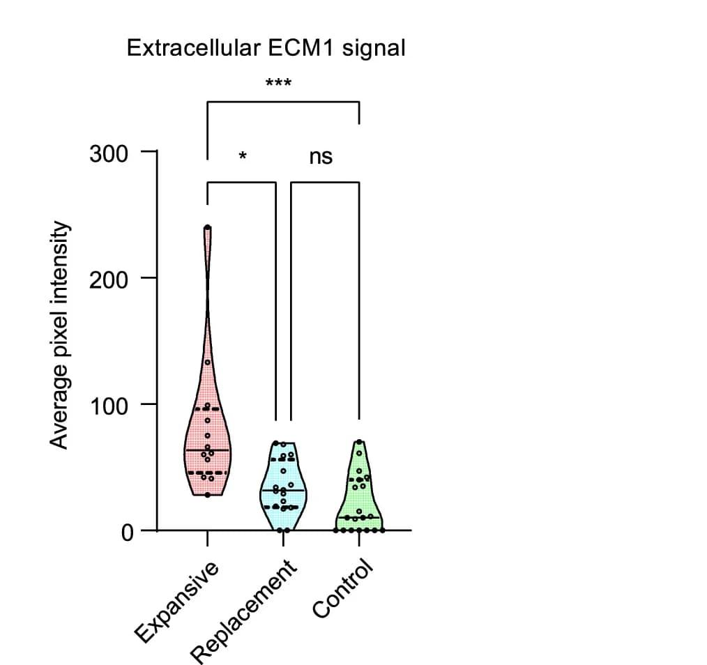 Open access visualization of Violin Plot, Box Plot, Scatter Plot, Extracellular ECM1 Expression, DCIS Lesions