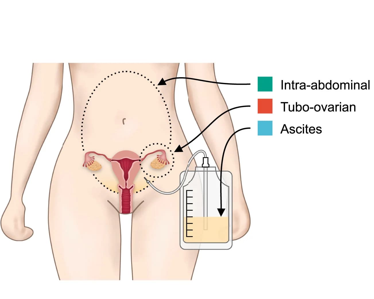 Open access visualization of Illustration, Anatomical Sites, Omentum, Peritoneum, Bowel Mesenterium