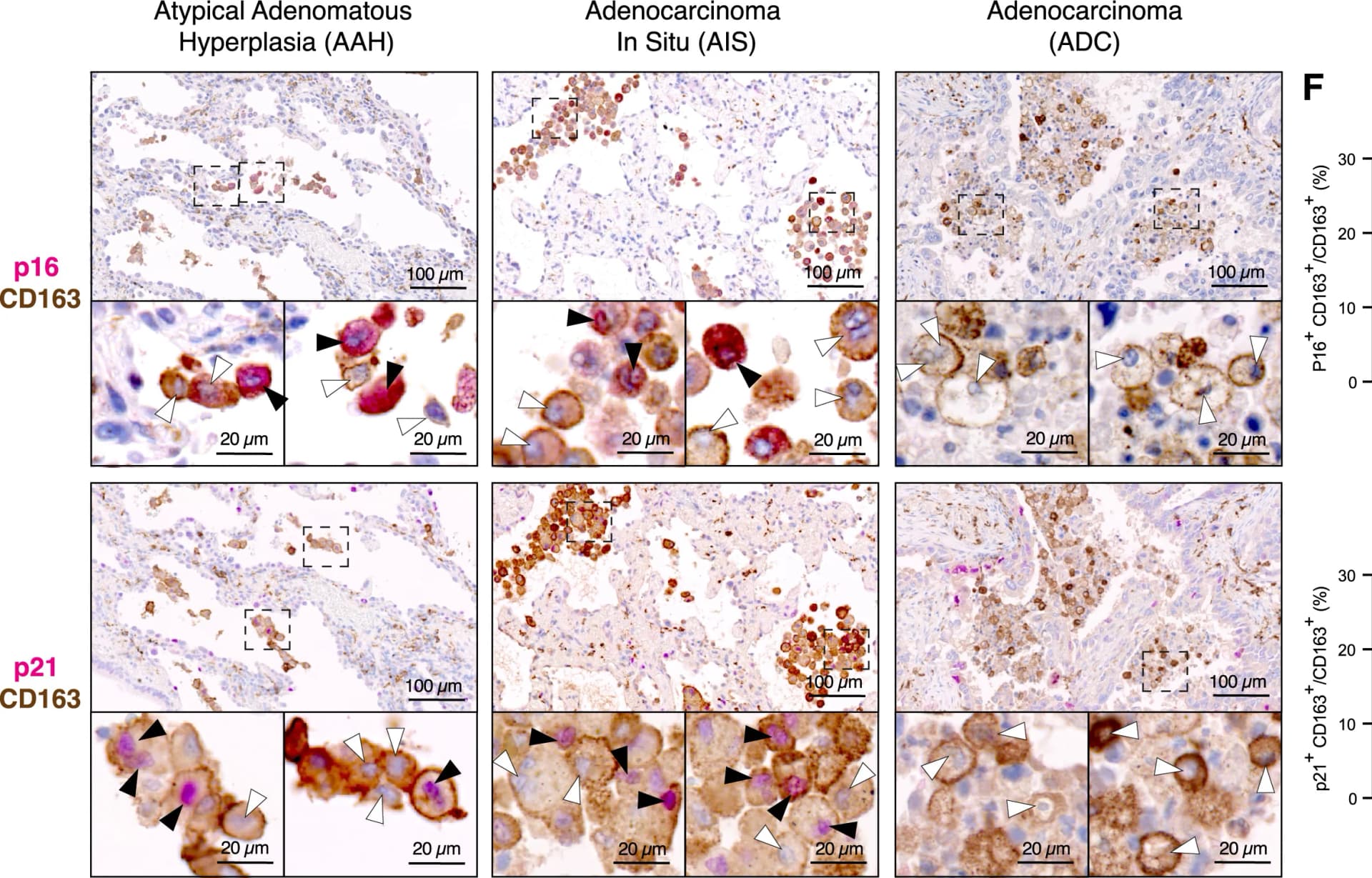 Open access visualization of Microscopy, Bar Plot, Double Immunohistochemistry, CD163-positive Macrophages, p16INK4a