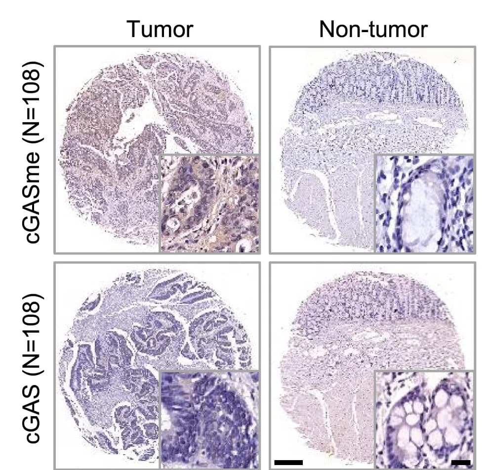 Open access visualization of Microscopy, cGAS Methylation, Immunohistochemistry, Colorectal Cancer, Tissue Microarray