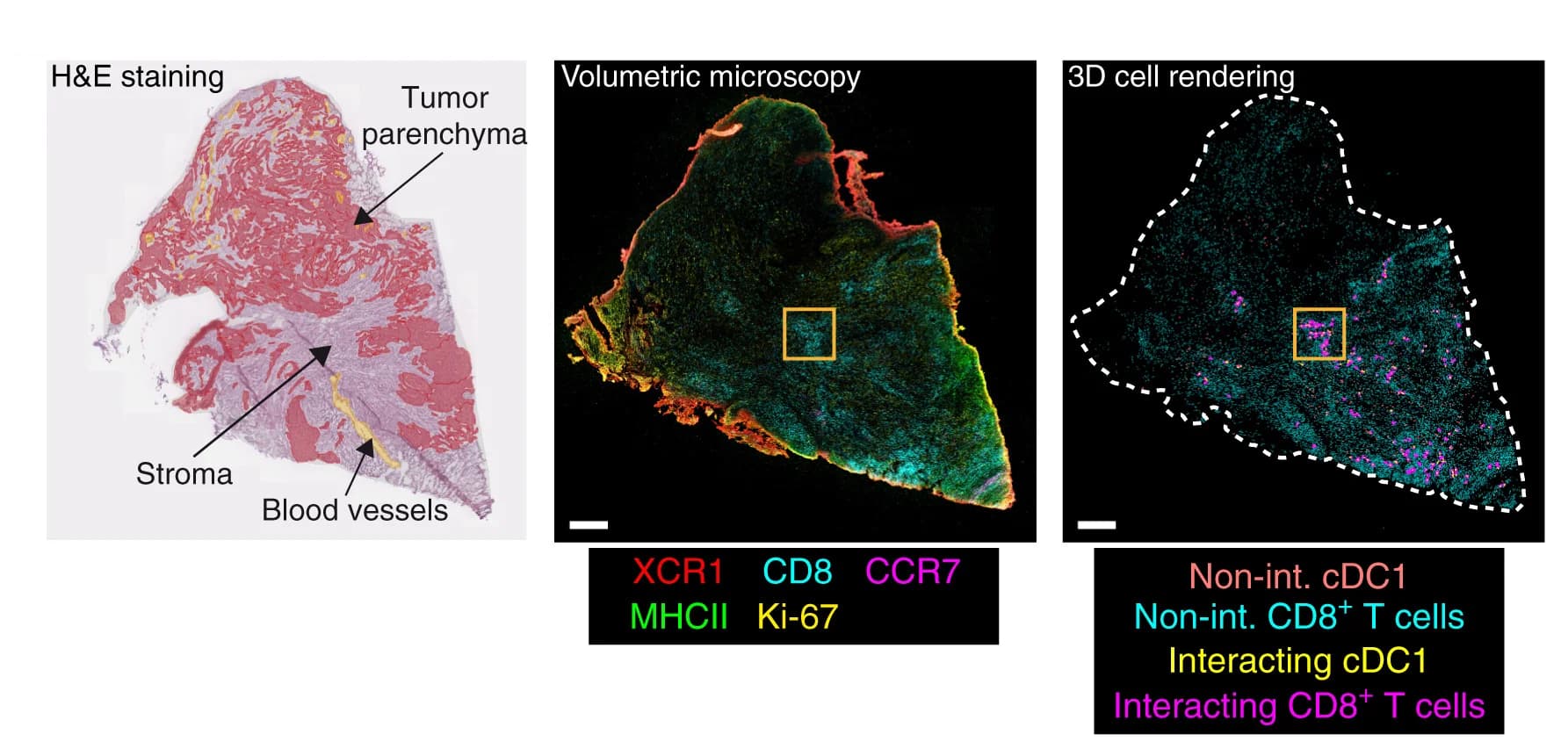 Open access visualization of Microscopy, HNSCC Tumor, Stromal Region, Parenchymal Region, H&E