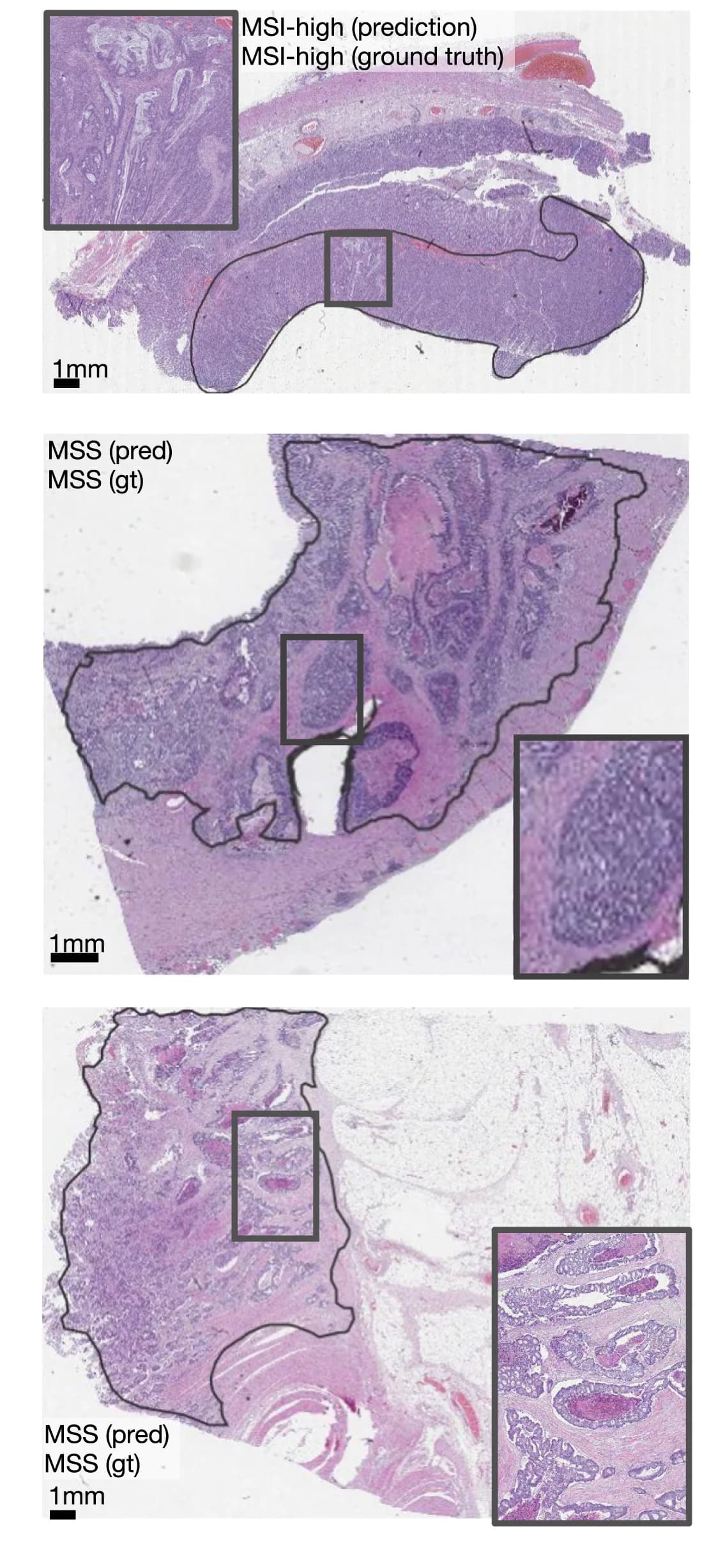 Open access visualization of Microscopy, Resection Specimen, Tumor Regions, Slides