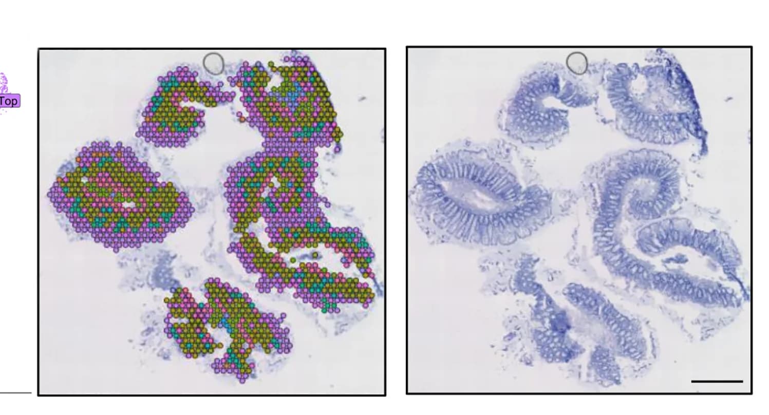 Open access visualization of Microscopy, Spatial Distribution, Transcriptome Clusters, Spatial Transcriptomics, Colon Biopsy