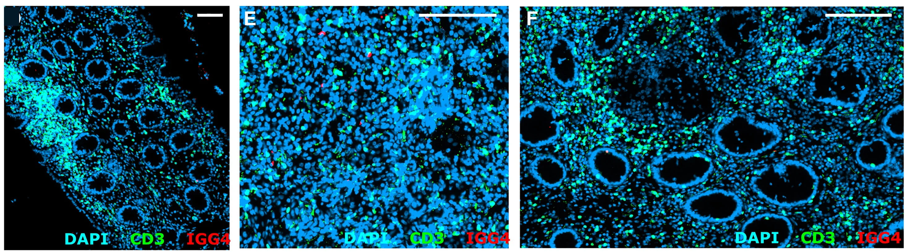 Open access visualization of Microscopy, Immunofluorescence, CPI-Bound T Cells, IgG4, CD3