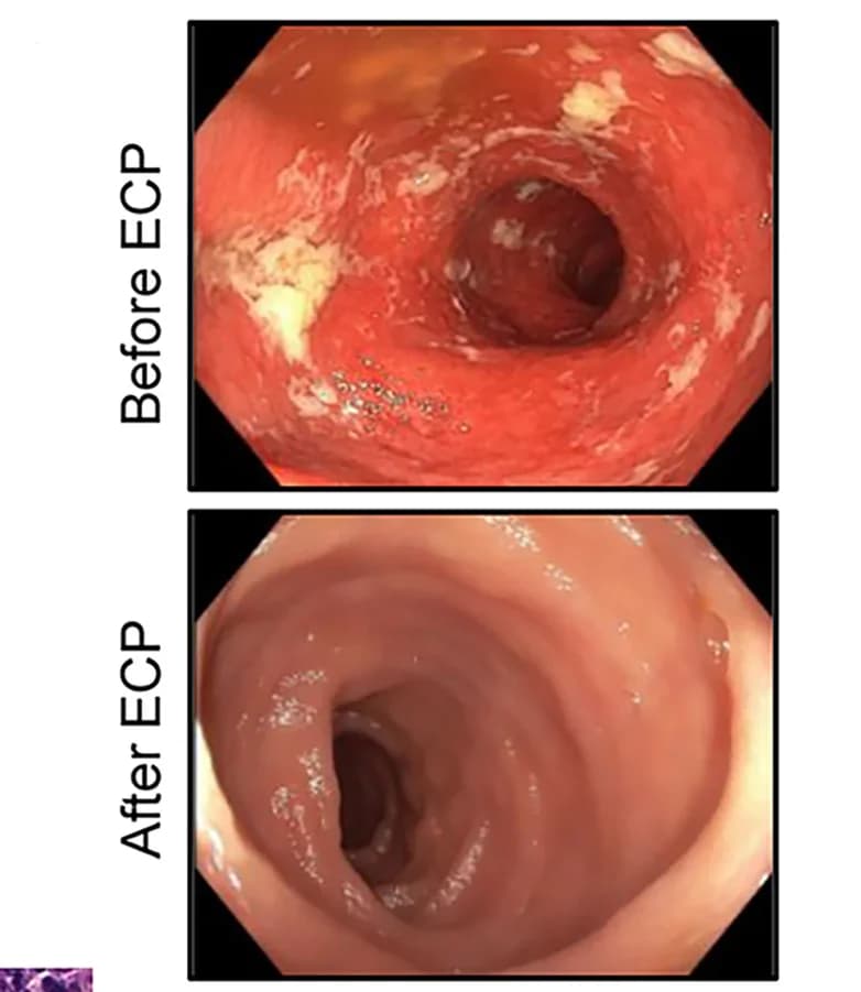 Open access visualization of Photo, Endoscopic Images, ICI-Induced Colitis, ECP Therapy