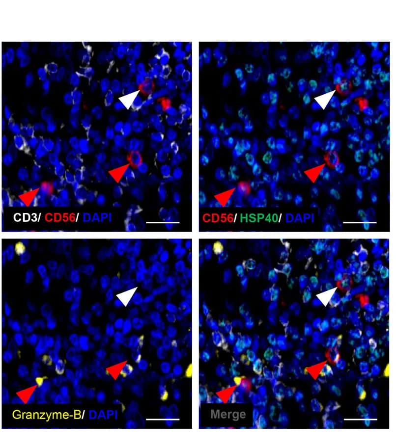 Open access visualization of Microscopy, HCC Tumor, Multiplex Immunofluorescence, Granzyme B, HSP40+NK Cells