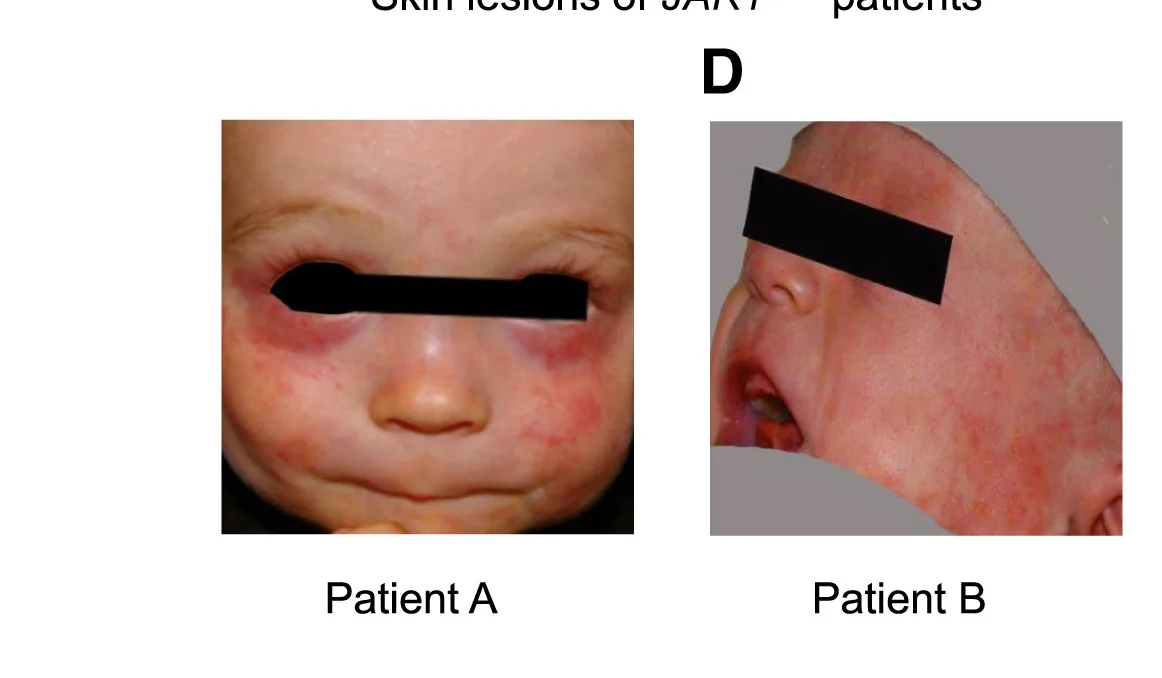 Open access visualization of Photo, AD, Skin Lesions, JAK1, GoF Mutation