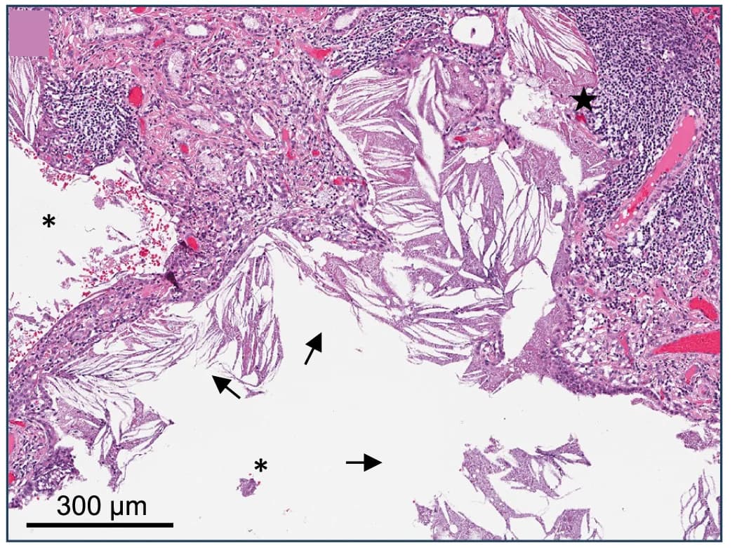 Open access visualization of Microscopy, Photomicrographs, Lung Biopsy, Cysts, Eosinophilic Material