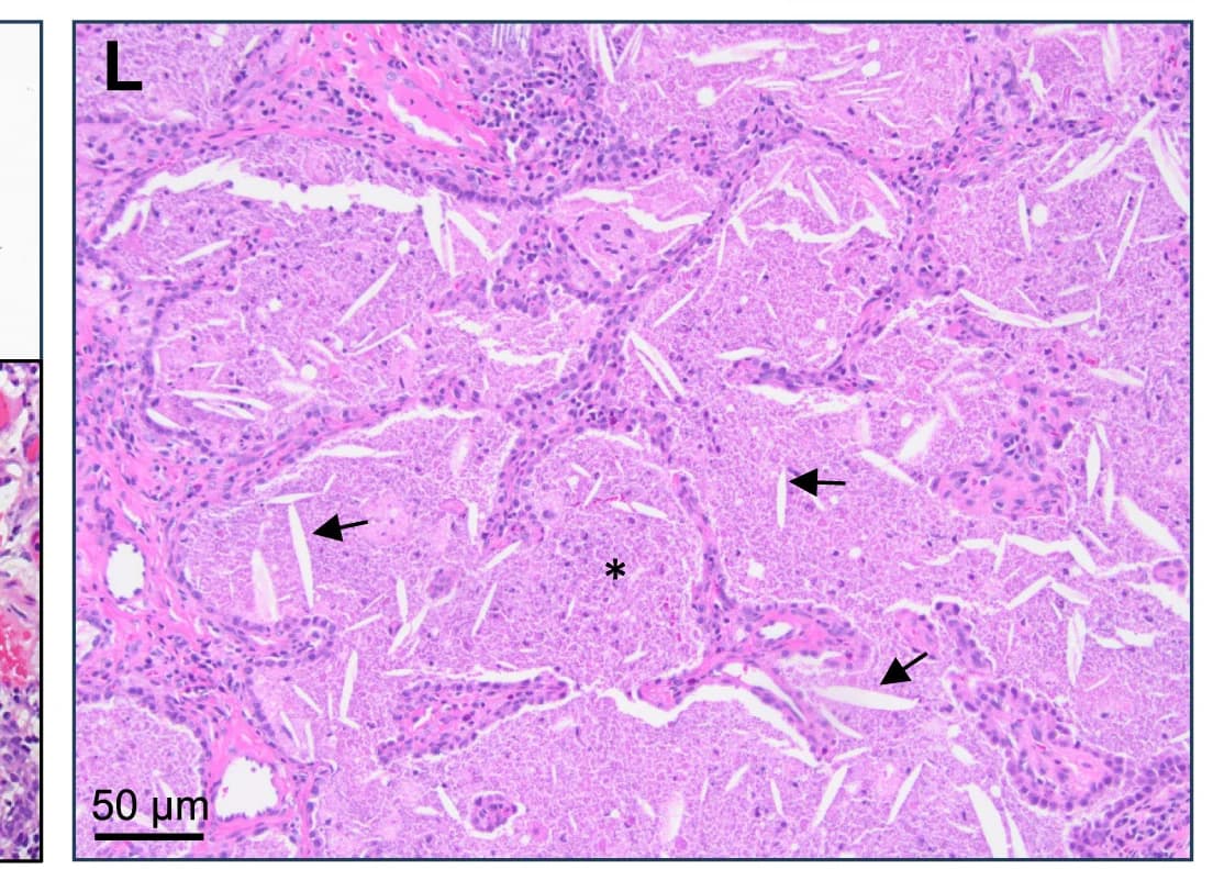 Open access visualization of Microscopy, Cysts, Epithelial Cells, Surfactant Protein C