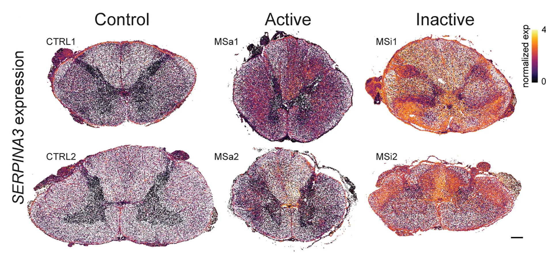 Open access visualization of Microscopy, Spatial Maps, Cells, SERPINA3N Expression