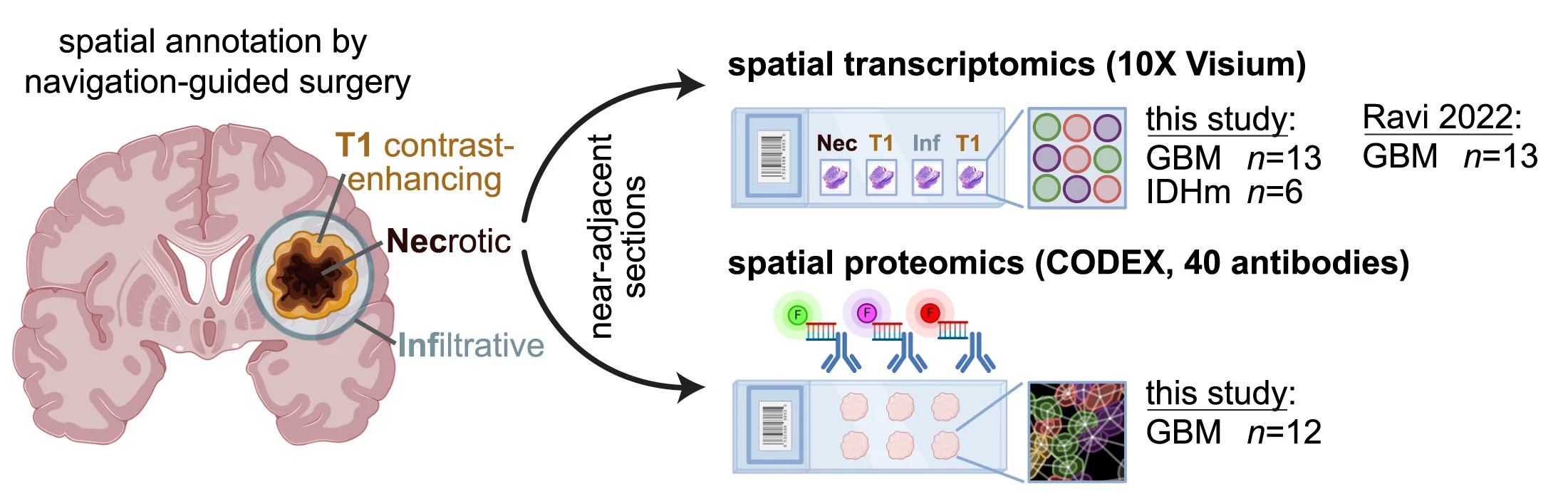 Open access visualization of Illustration, Workflow, Glioblastoma, IDH-Mutant Gliomas, Visium