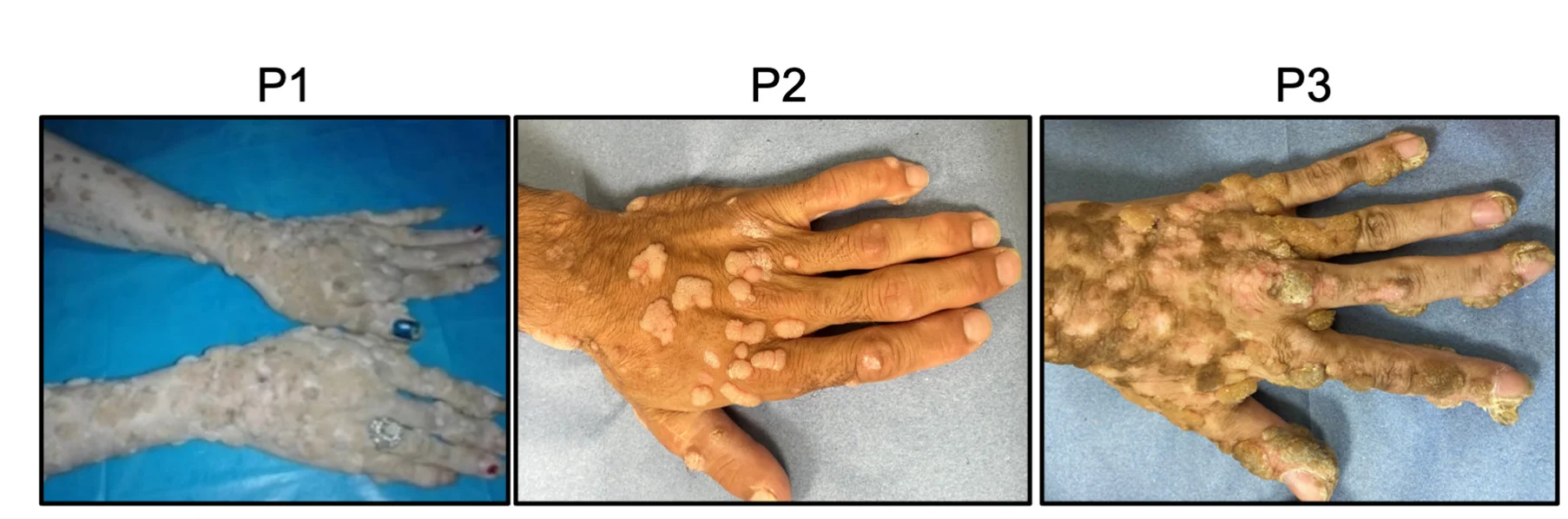 Open access visualization of Photo, Cutaneous Warts, Hands
