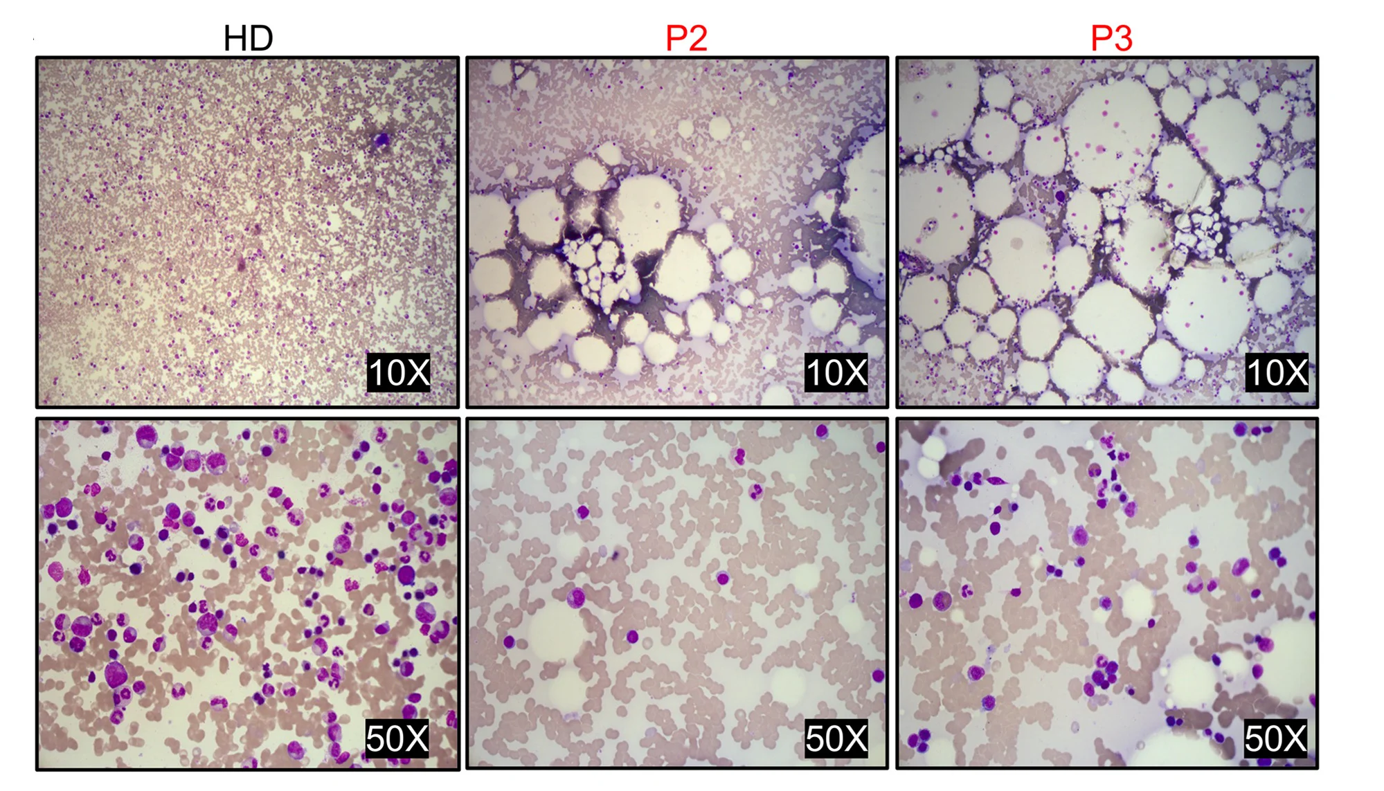 Open access visualization of Microscopy, Light Microscopy, Bone Marrow Smears, May-Grumwald-Giemsa Staining, Nucleated Cells