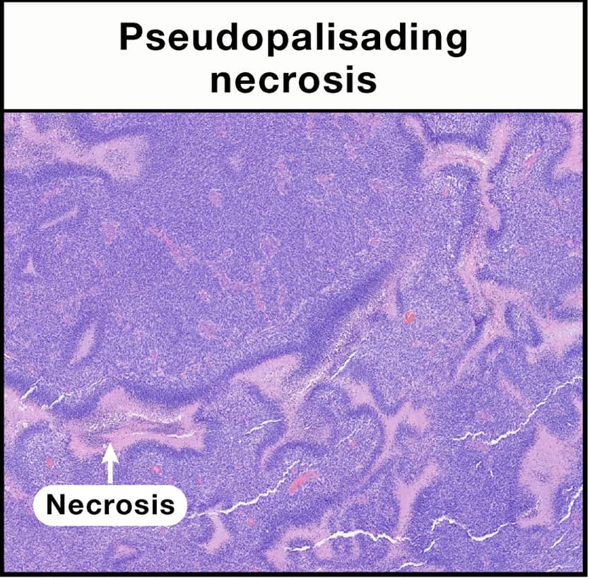 Open access visualization of Microscopy, Pseudopalisading Necrosis, Glioblastoma