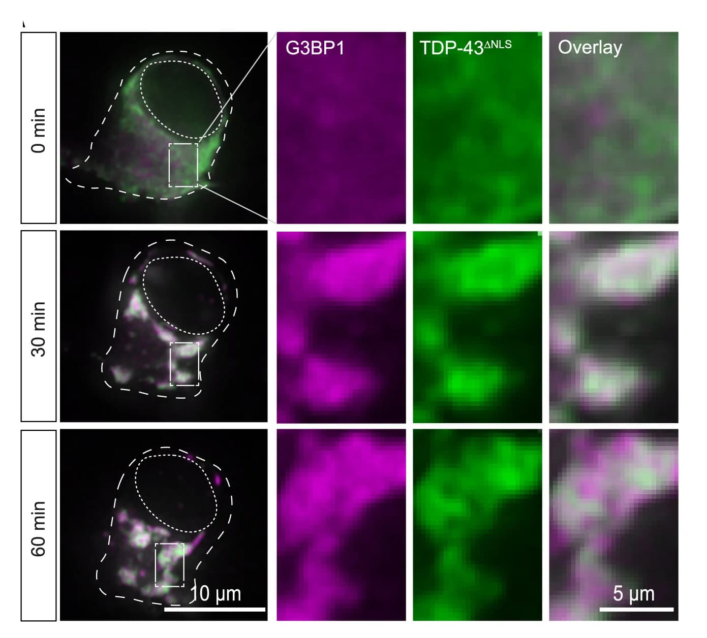 Open access visualization of Microscopy, TDP-43 Demixing, iPS-MNs, GFP-tagged TDP-43ΔNLS, mCherry-tagged G3BP1