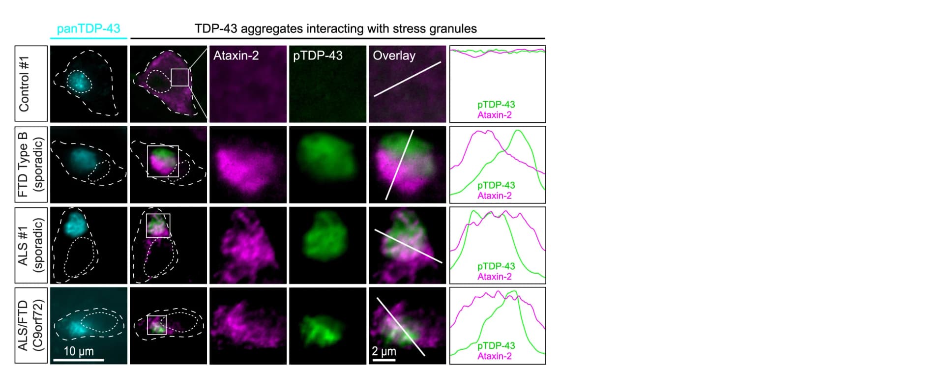 Open access visualization of Microscopy, Line Plot, Neurons, Sporadic Type B FTD, Sporadic ALS