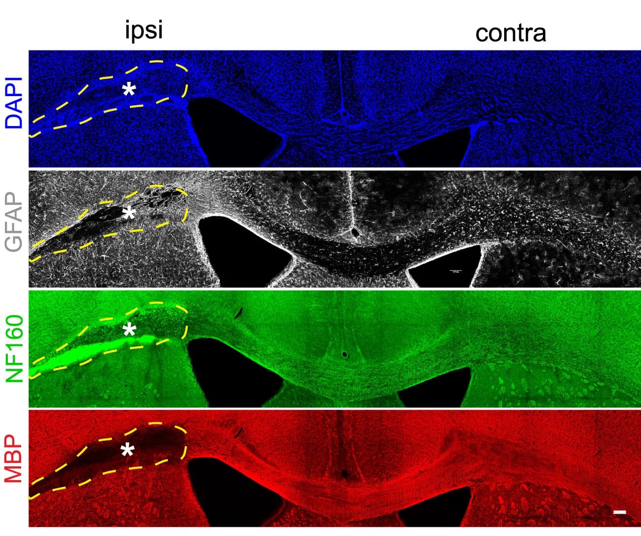 Open access visualization of Microscopy, Immunostaining, Infarct, Demyelination, Axon Damage