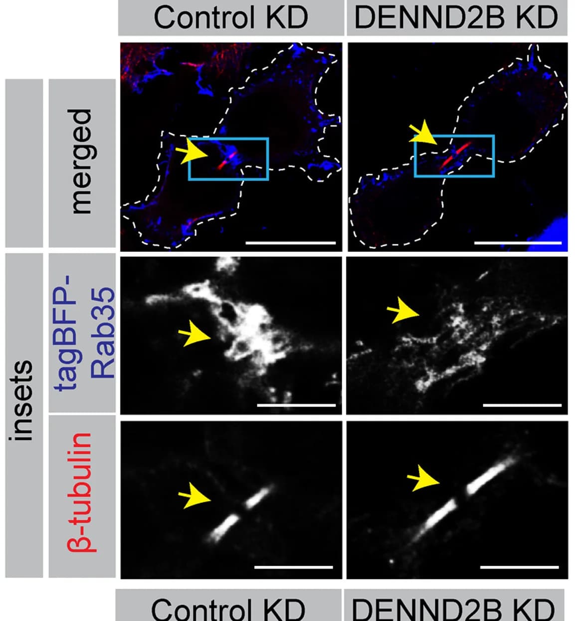 Open access visualization of Microscopy, HeLa Cells, tagBFP-Rab35, DENND2B shRNA lentivirus, β-tubulin