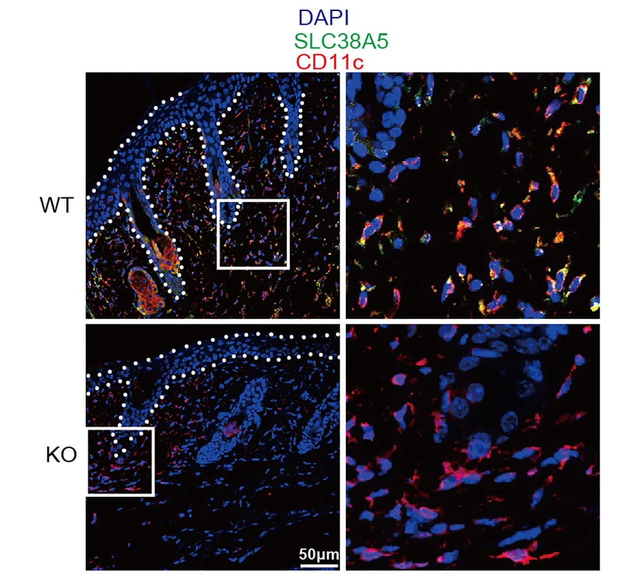 Open access visualization of Microscopy, Confocal Microscopy, Psoriatic Lesion, SLC38A5 Antibody, DC Marker CD11c