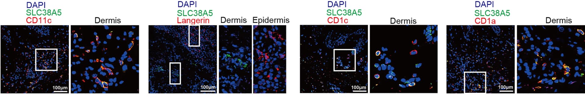 Open access visualization of Microscopy, Confocal Microscopy, Psoriatic Lesions, SLC38A5 Antibody, DAPI