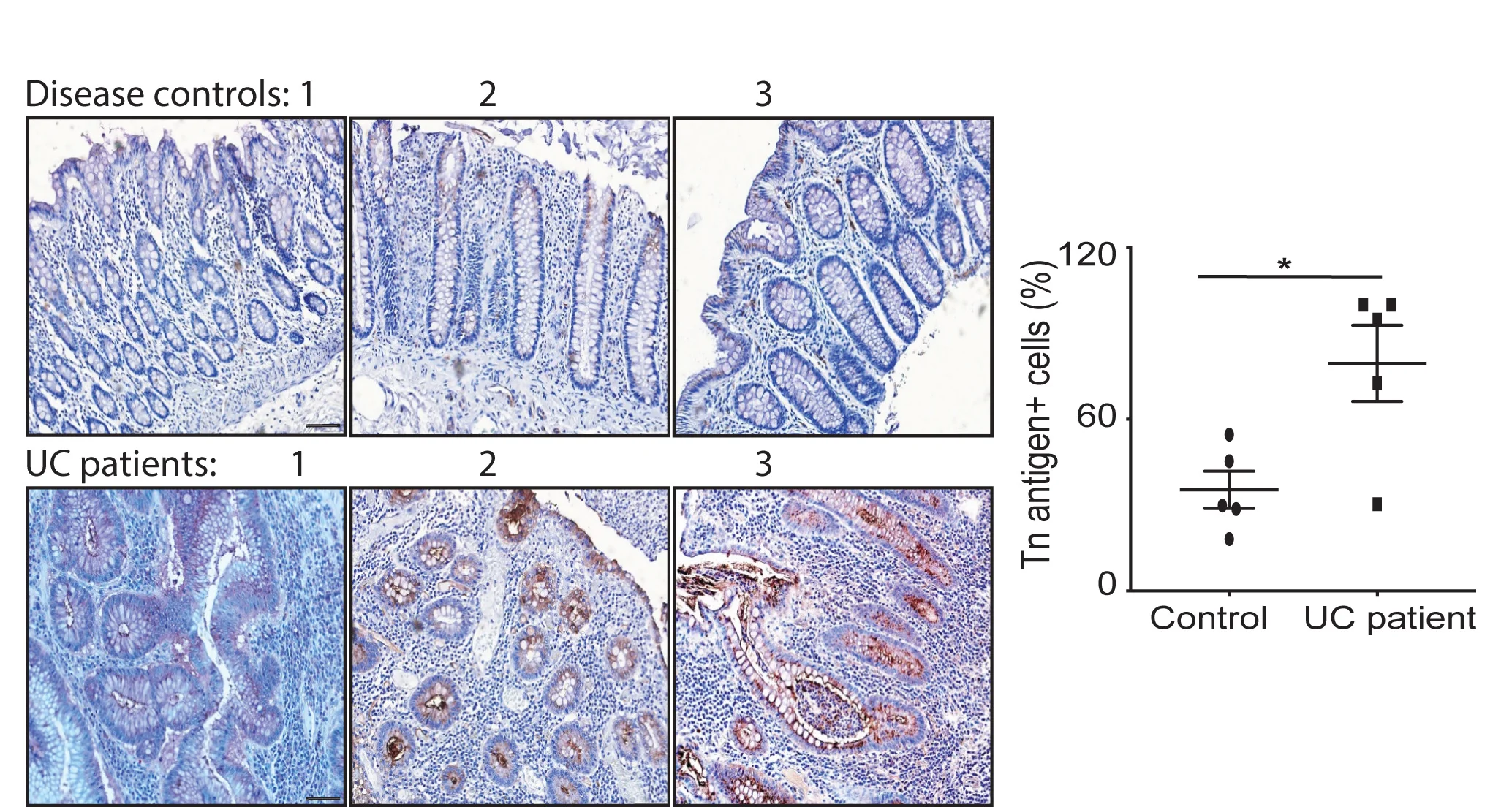 Open access visualization of Microscopy, Scatter Plot, Error Bars, Immunohistochemistry, Tn Antigen