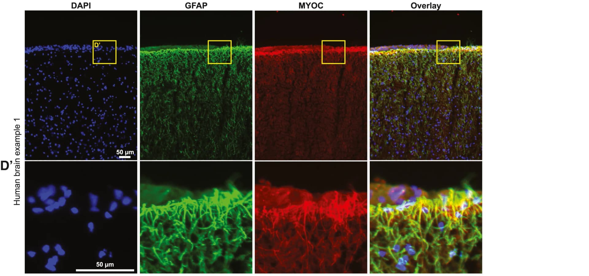 Open access visualization of Microscopy, Immunohistochemistry, GFAP+, MYOC+ Astrocytes, Postmortem Human Brain Tissue