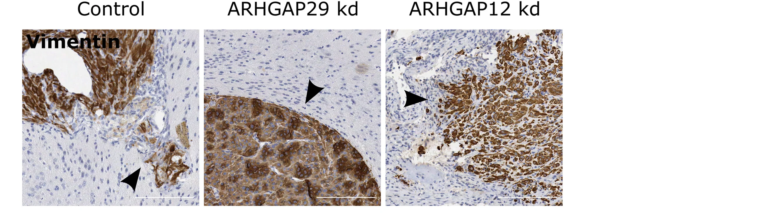 Open access visualization of Microscopy, Mouse Brain Tissue, Intracranial Tumors, Immunohistochemical Staining, Vimentin