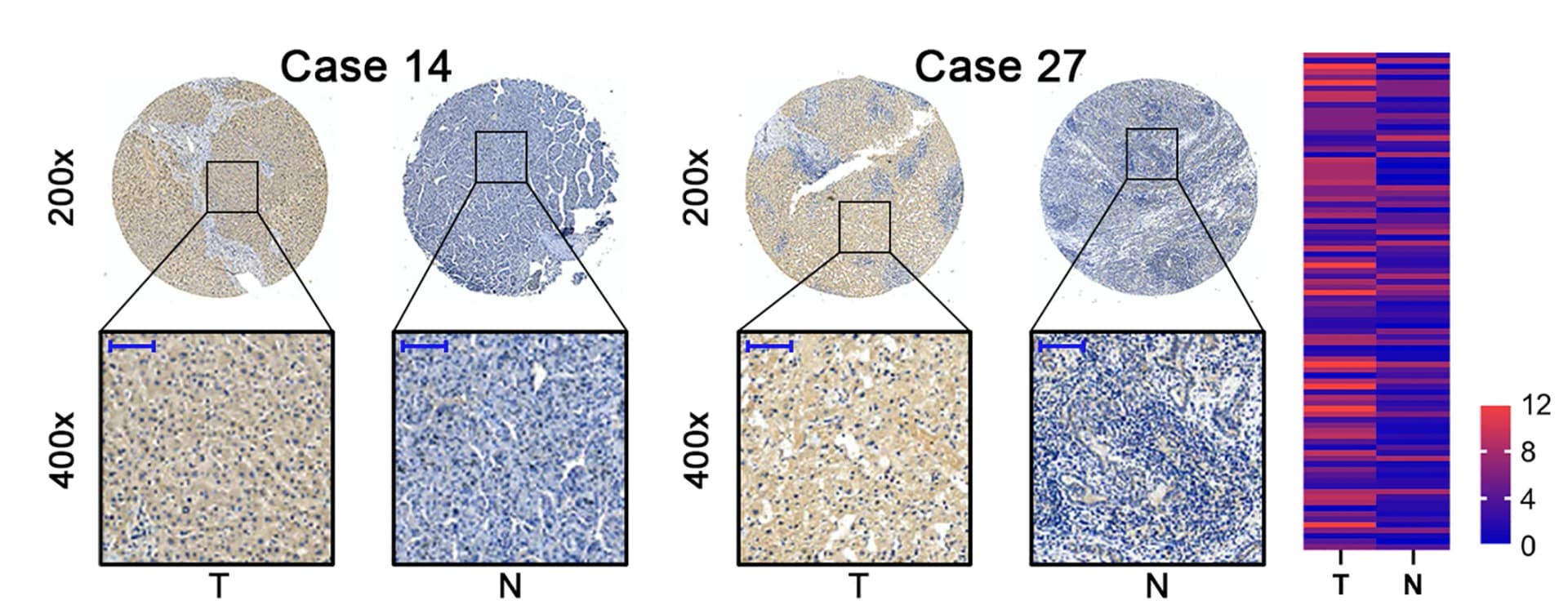 Open access visualization of Microscopy, Heatmap, Tissue Microarray, TK1 Expression, HCC Specimens