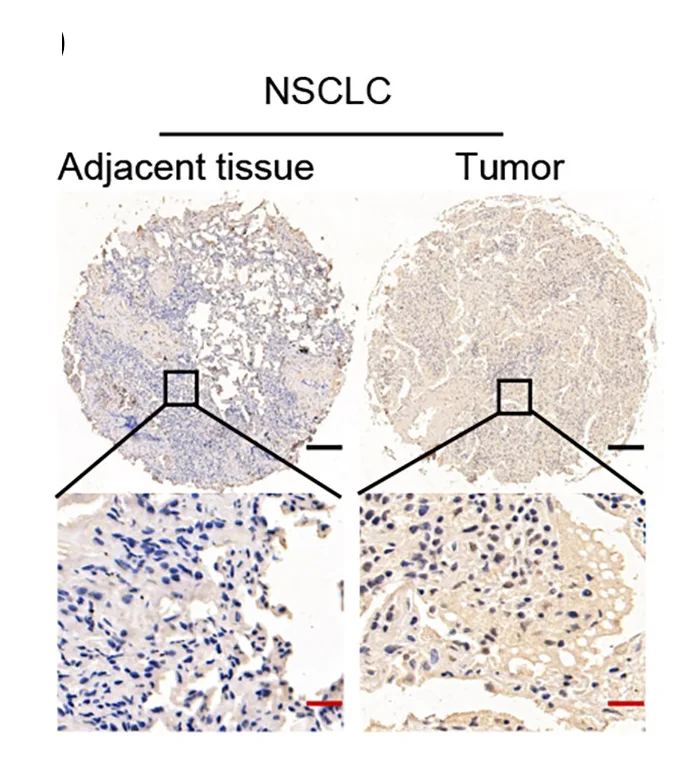 Open access visualization of Microscopy, Immunohistochemistry, IHC, SLC13A3 Expression, NSCLC