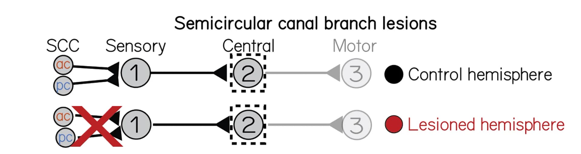Open access visualization of Workflow, Flowchart, Circuit Schematic, Semicircular Canal, VIIIth Nerve Lesion