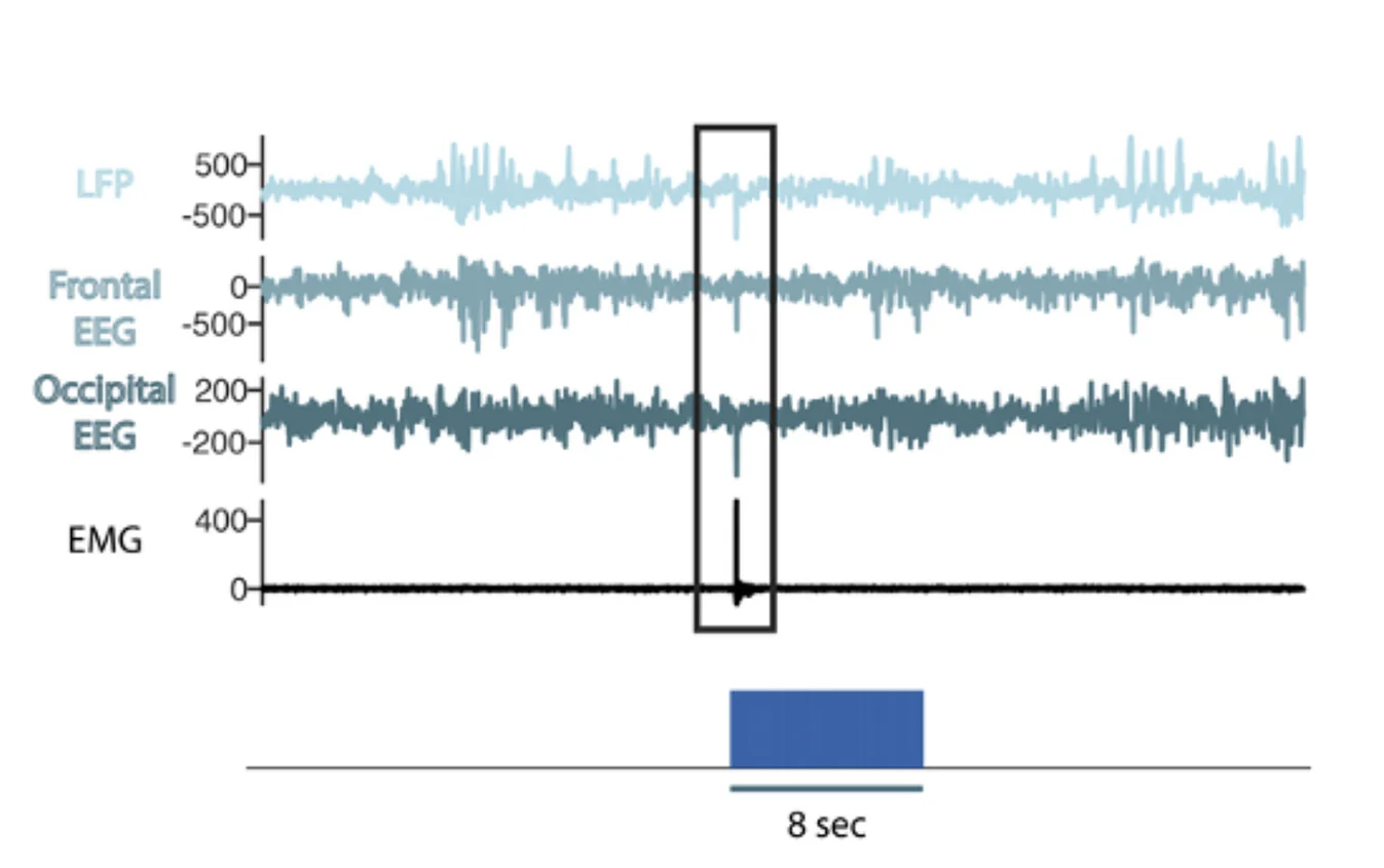 Open access visualization of Line Plot, Line Step, Muscle Twitch, Artifacts, LFP