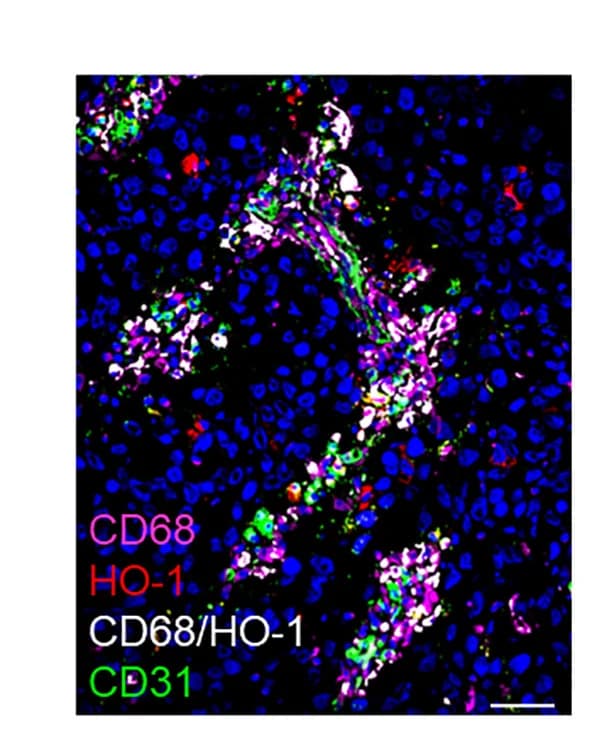 Open access visualization of Microscopy, Frozen Section, Human Invasive Ductal Carcinoma, DAPI, CD68