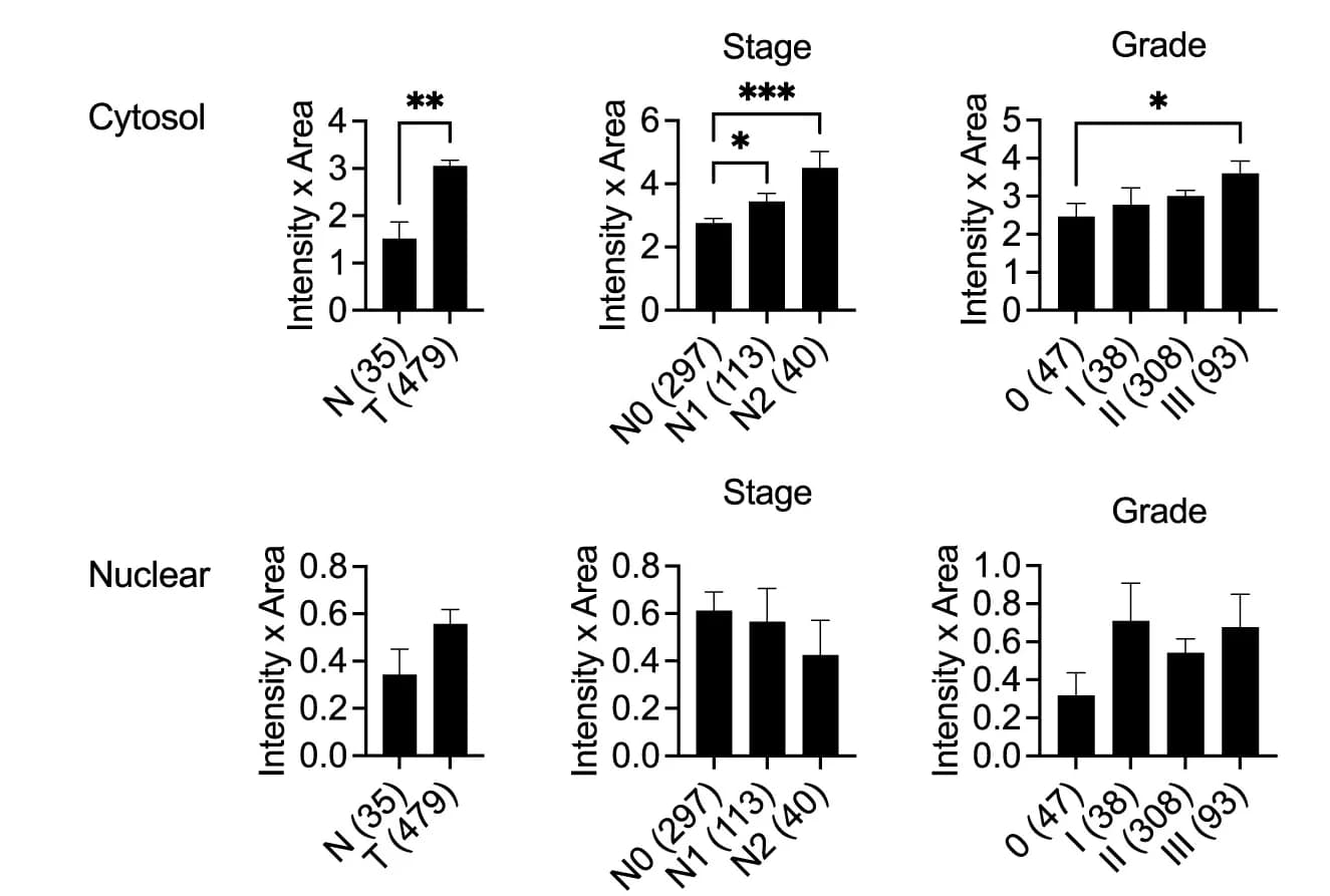 Open access visualization of Bar Plot, Error Bars, KIF2C Expression, Tumor Stages, Lymph Node Metastasis