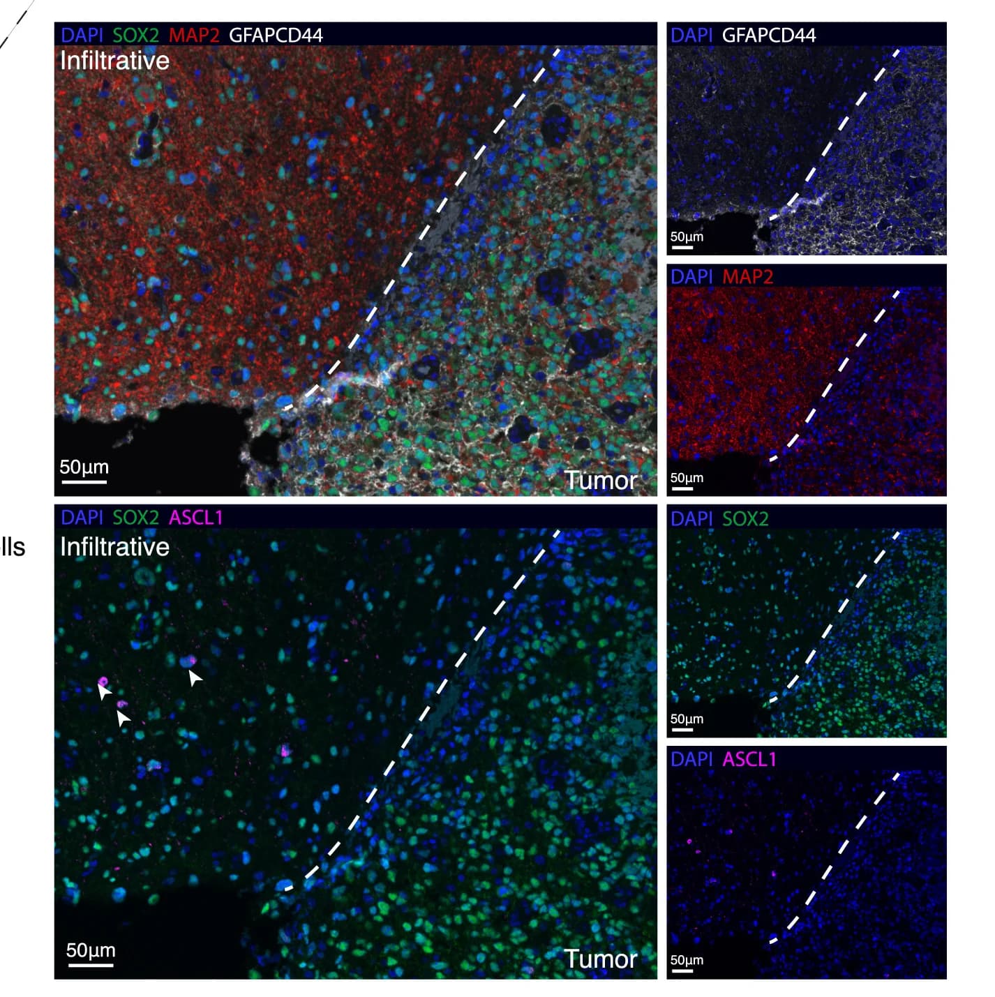 Open access visualization of Microscopy, Malignant Markers, GFAP/CD44, MAP2, SOX2