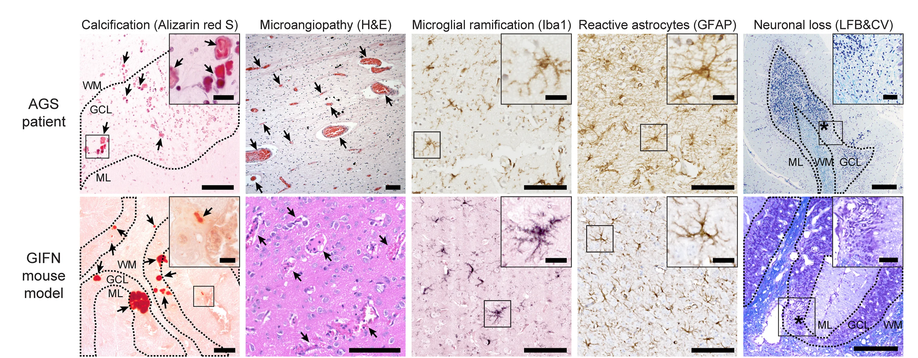 Open access visualization of Microscopy, Calcification, Alizarin Red S Stain, AGS, TREX1 Mutation